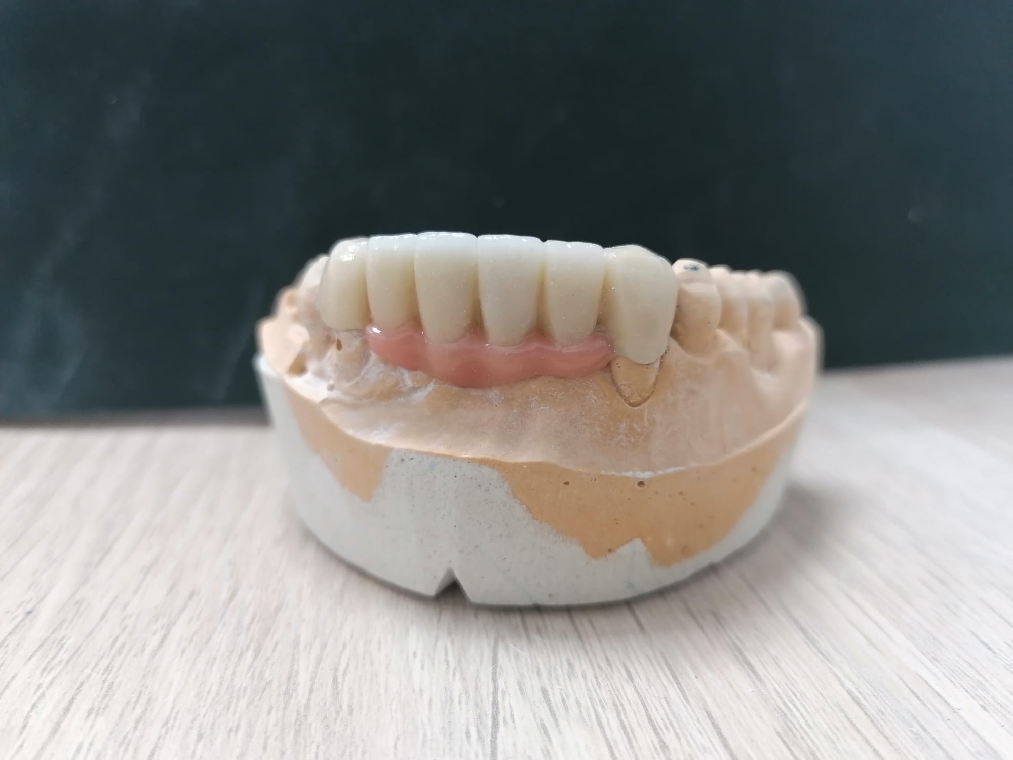 Protesis fija puente de 6 piezas con porcelana gingival