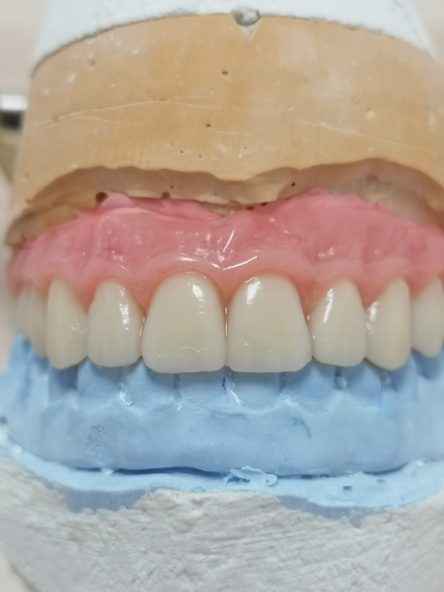 Protesis fija hibrida metal-resina con estructura metalica sintetizada sobre 6 impantes