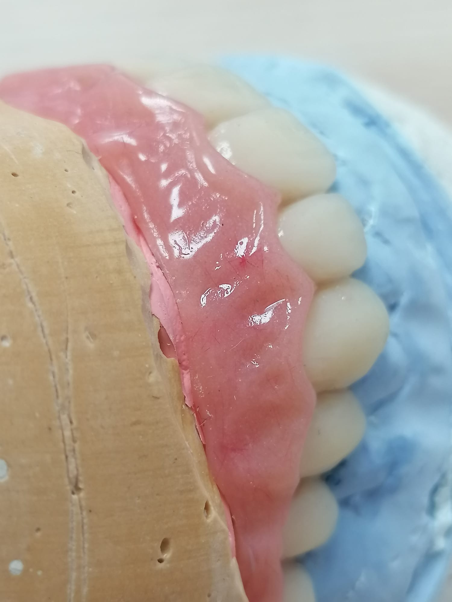Protesis fija hibrida metal-resina con estructura metalica sintetizada sobre 6 impantes