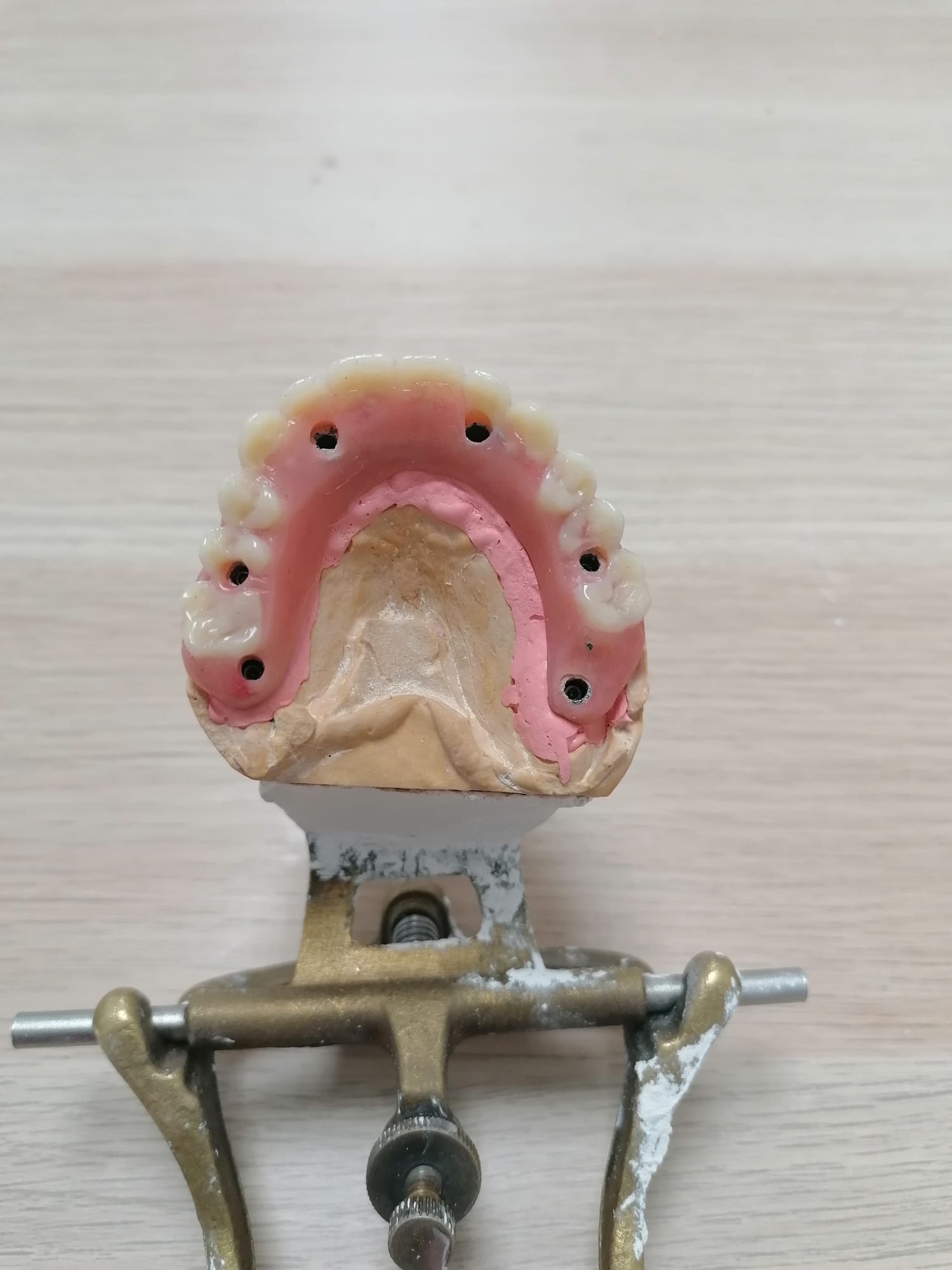 Protesis fija hibrida metal-resina con estructura metalica sintetizada sobre 6 impantes