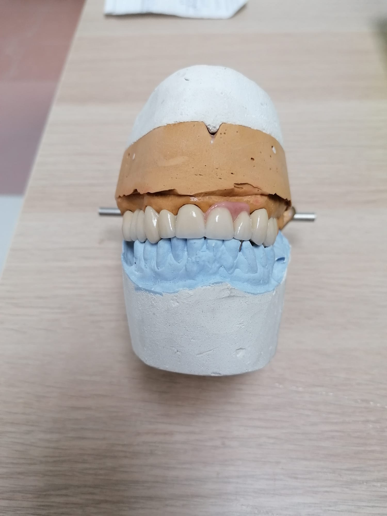 Protesis fija rehabilitacion superior metal-ceramica