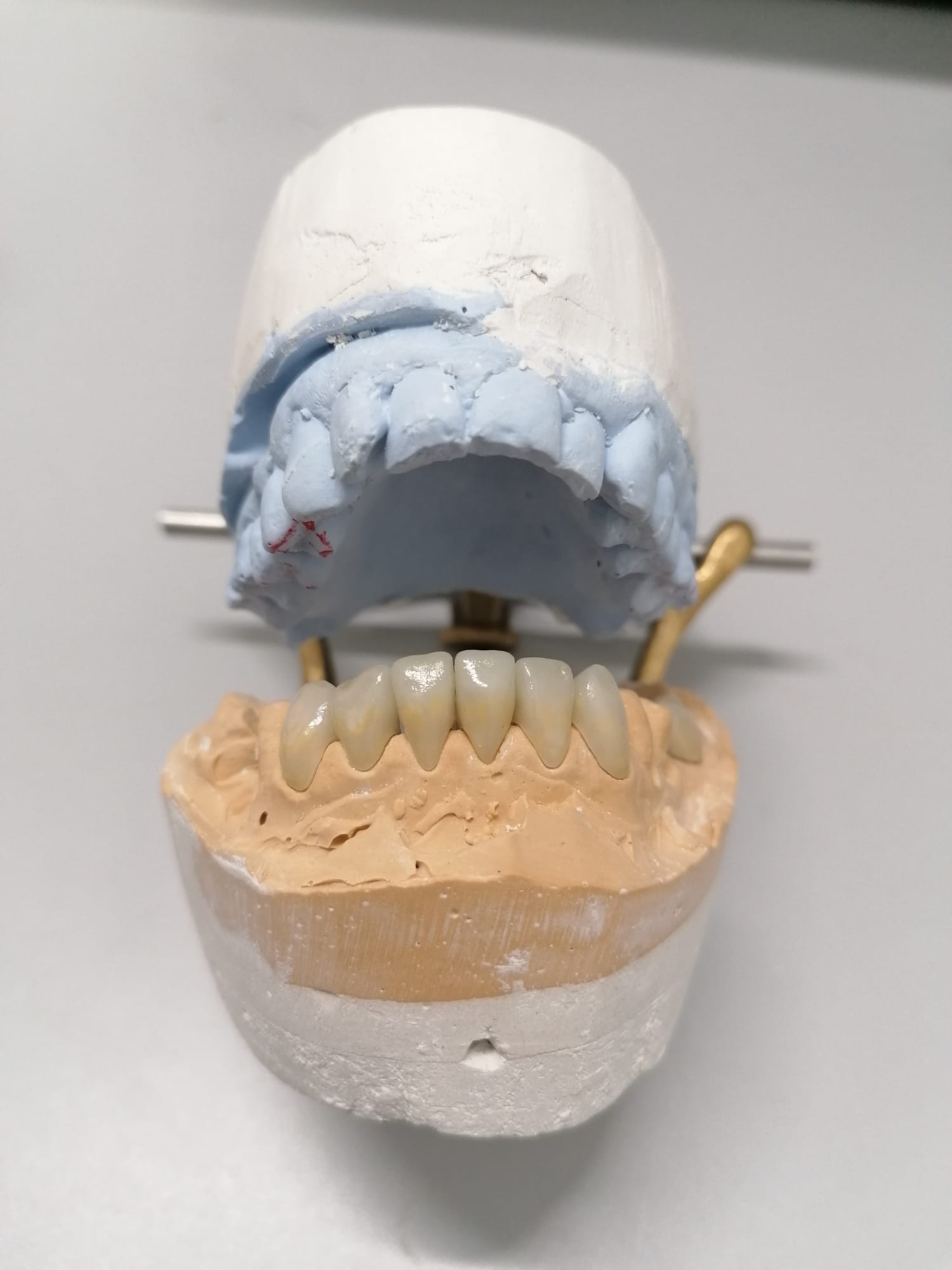 Protesis fija rehabilitacion superior metal-ceramica
