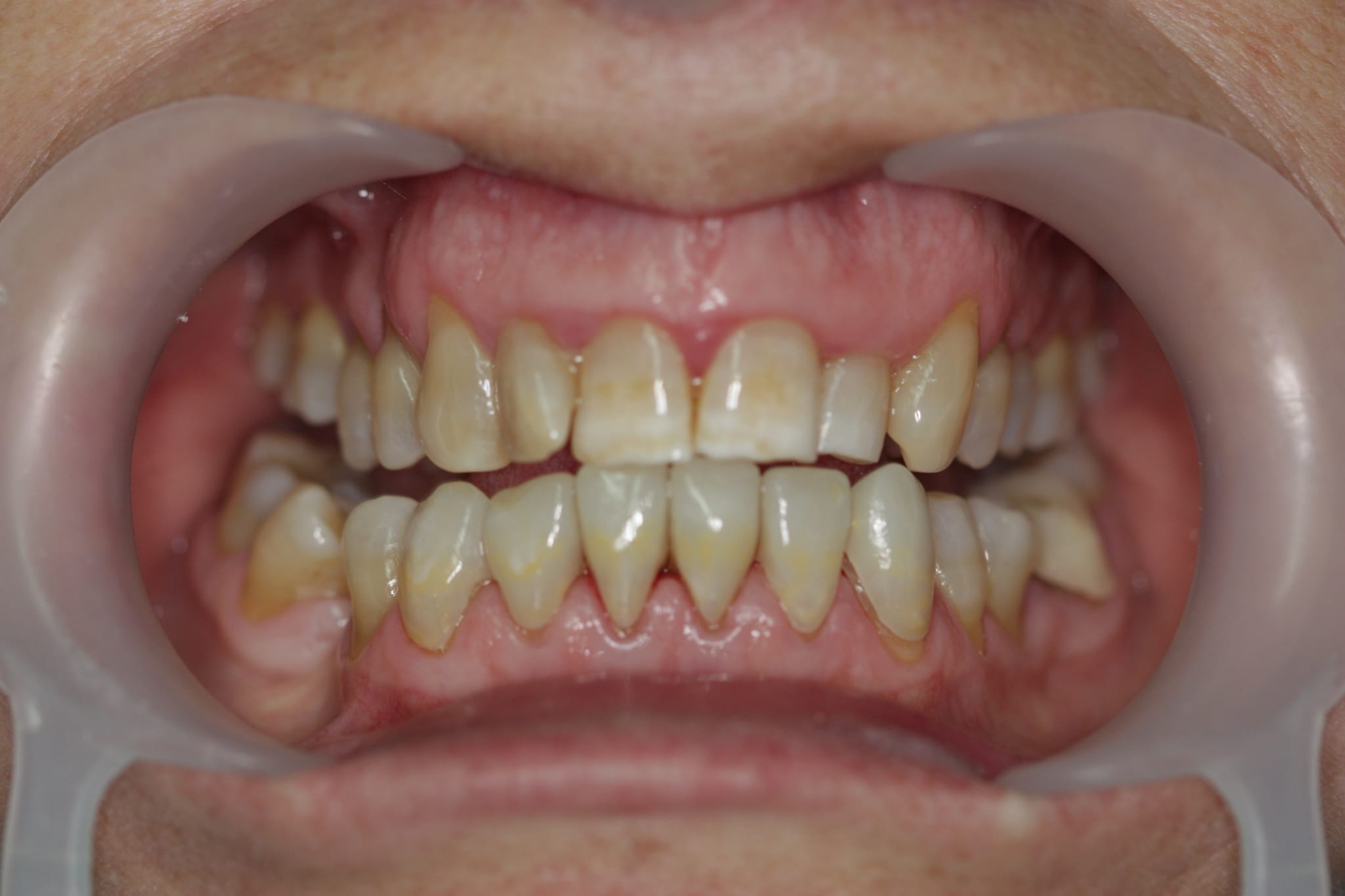 Protesis removible Smilelab
