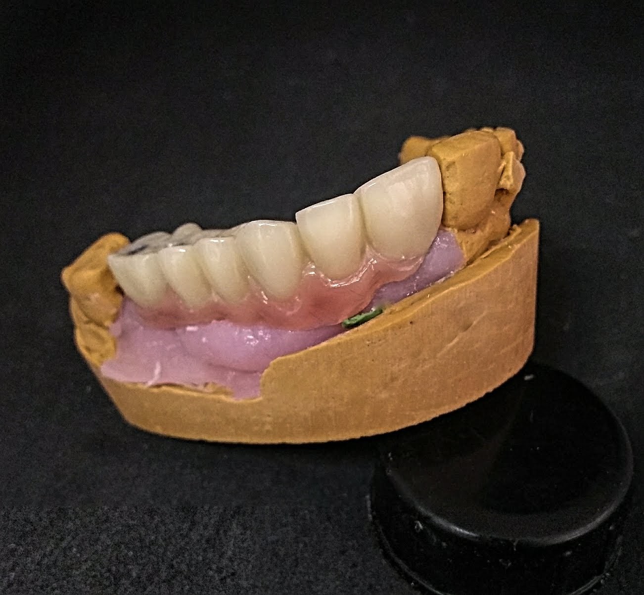 Puente de 21 a 26 sobre implantes provisional con resinas de alto impacto