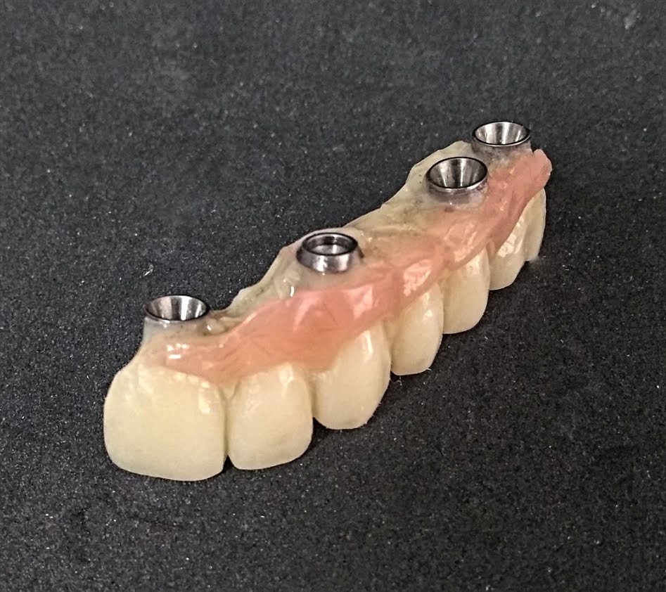 Puente de 21 a 26 sobre implantes provisional con resinas de alto impacto
