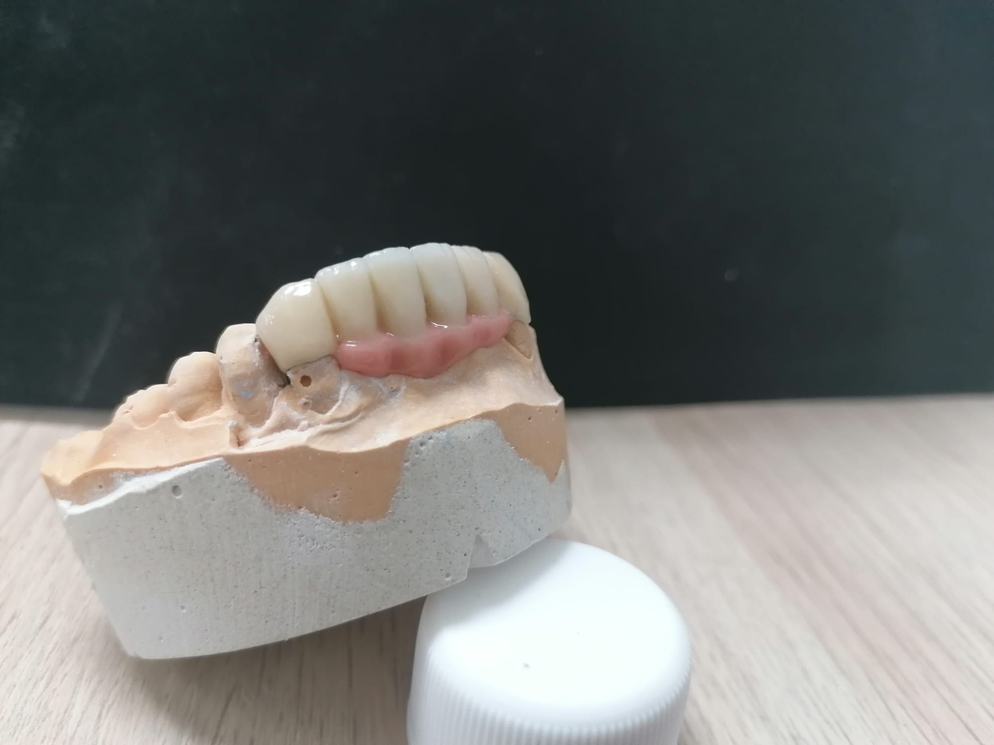 Protesis fija puente de 6 piezas con porcelana gingival