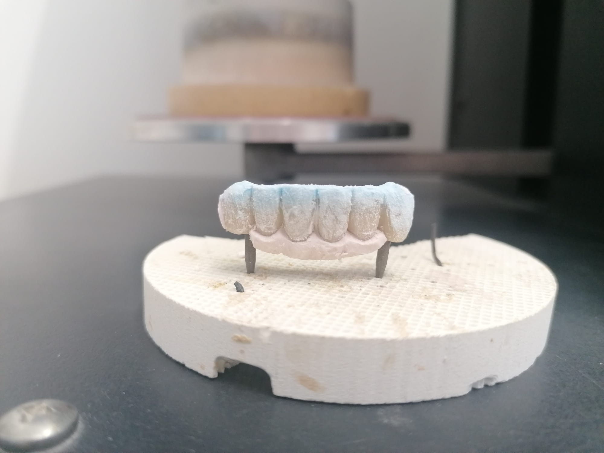 Protesis fija puente de 6 piezas con porcelana gingival