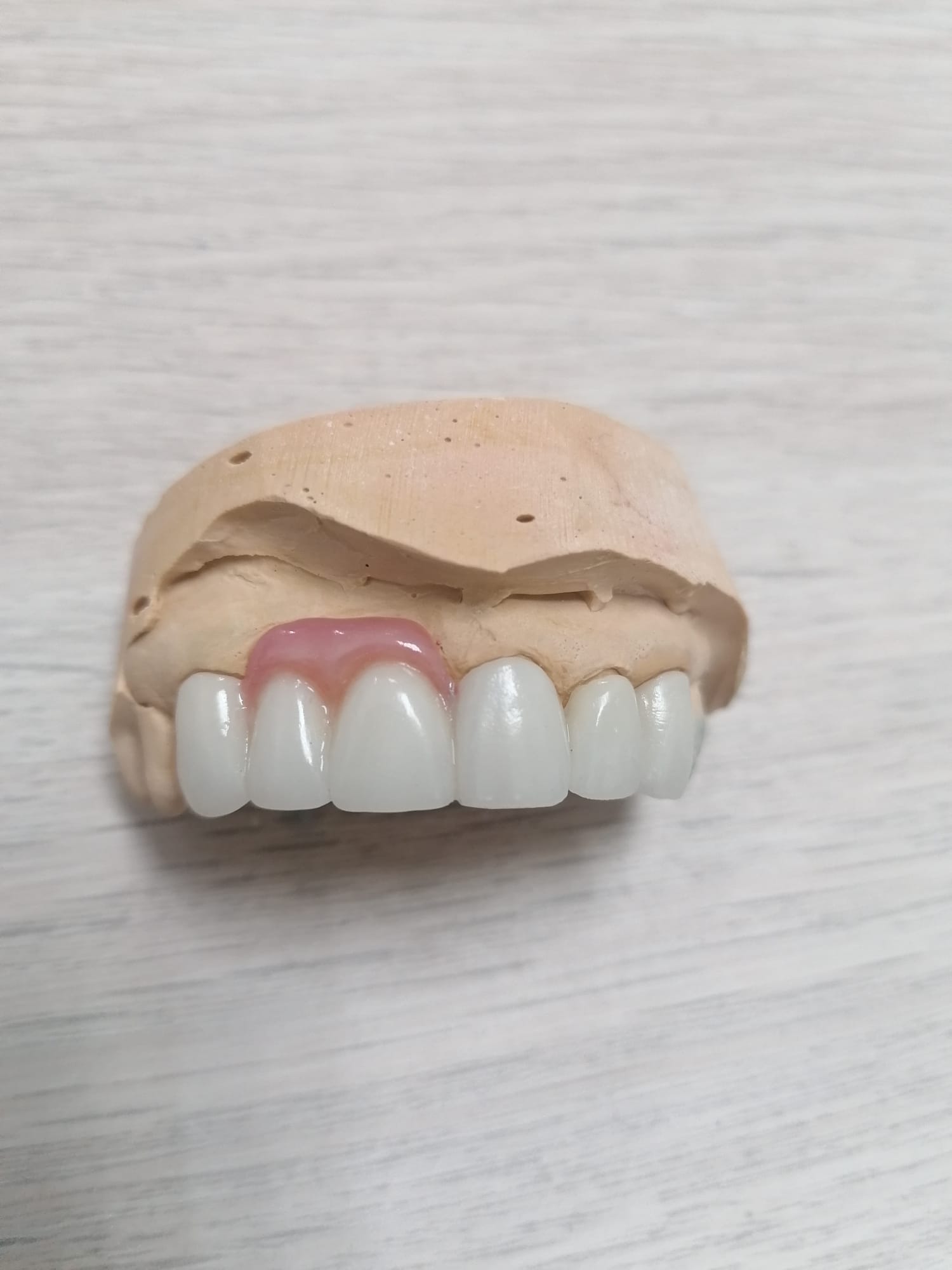 Protesis fija puente de 6 piezas anterior de zirconio con zona gingival