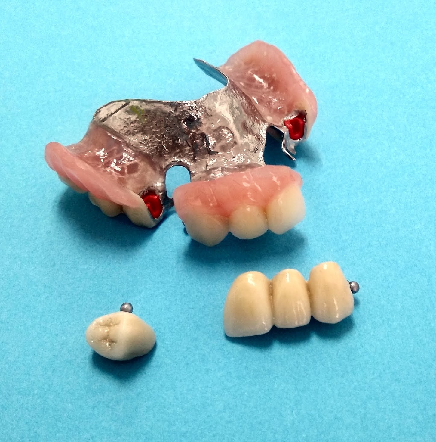 Puente anterior y corona ceramica