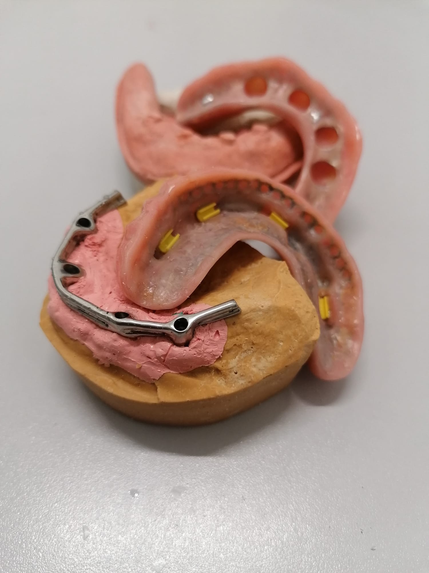 Protesis removible sobredentadura